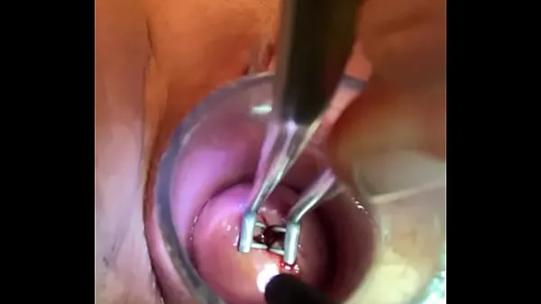 XXX 子宮頸管内検鏡 私の動画
